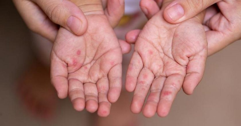El Ayak Hastalığı Belirtileri Nelerdir? El Ayak Hastalığı Nasıl Anlaşılır? Tedavi Yöntemleri Nelerdir?