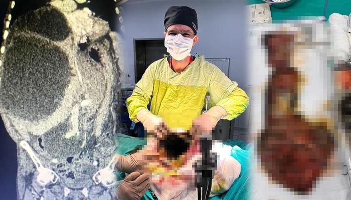 Dünya literatürüne giren vaka: Karnı ve karaciğeri kistle kaplıydı! 90 santimetreye ulaşan kedi-köpek kisti çıkarıldı! “Ölümüne sebep olabilir”