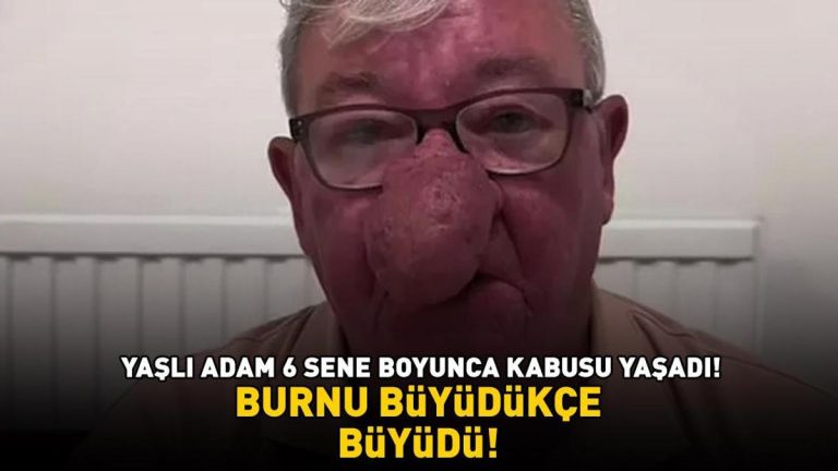 Burnu büyüdükçe büyüdü! 68 yaşındaki adam kabusu yaşadı! 4 saatlik operasyonla adeta yeniden doğdu